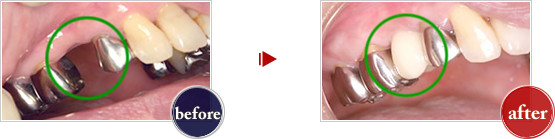 症例2：右側上顎中間欠損症例に対するインプラント治療