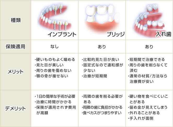 インプラント と 入れ歯 の 違い