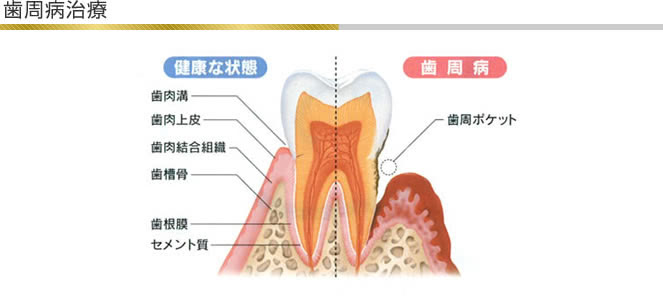 歯周病治療